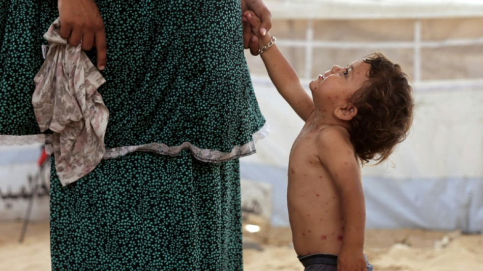 'All these rashes': chickenpox surges in Gaza camps